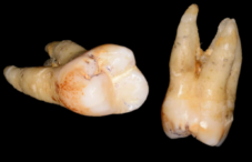 2. Molar OK